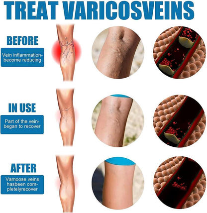 Vein Healing Varicose Veins Treatment Spray Pack of 1